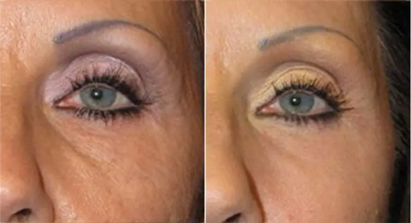 antes-y-despues-de-hialuronico-radiofreciencia-acidos-y-mesoterapia-3