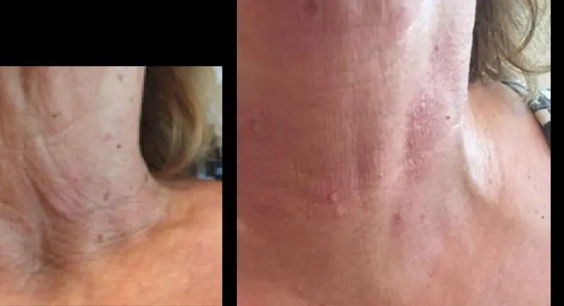 antes-y-despues-de-hialuronico-radiofreciencia-acidos-y-mesoterapia-4