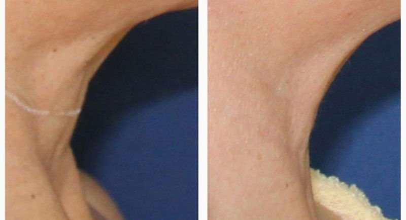 antes-y-despues-de-hialuronico-radiofreciencia-acidos-y-mesoterapia-5