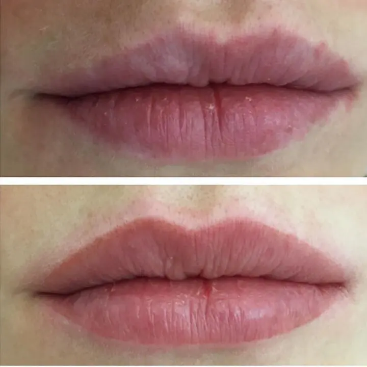 antes-y-despues-micropigmentacion-de-labios-5