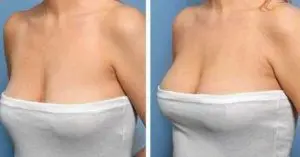 antes-y-despues-tratamiento-de-pecho-2