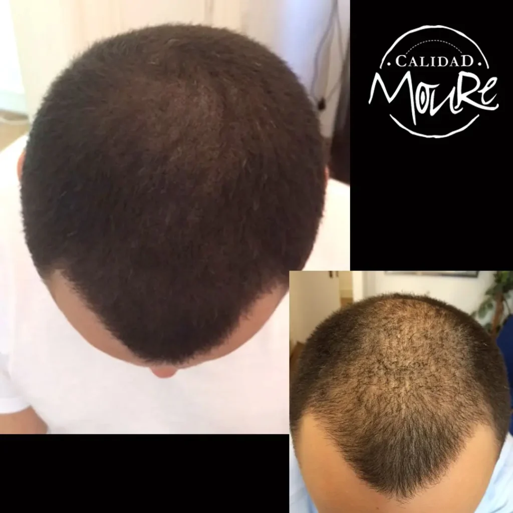 micropigmentacion-capilar-hombre-relleno-pelo-largo-1-1