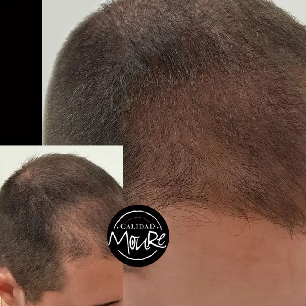 micropigmentacion-capilar-hombre-relleno-pelo-largo-2