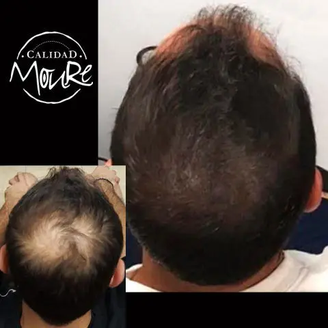 micropigmentacion-capilar-hombre-relleno-pelo-largo-3-1-480x480.jpg