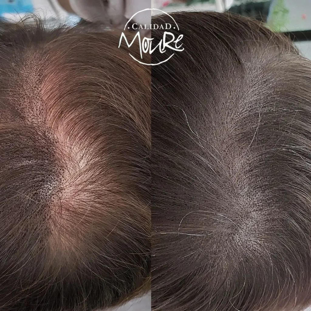 micropigmentacion-capilar-hombre-relleno-pelo-largo-4-1