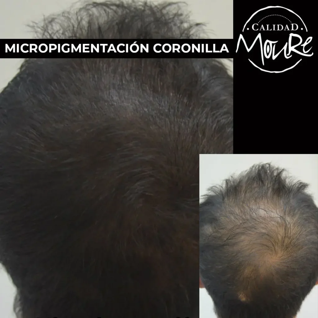 micropigmentacion-capilar-hombre-relleno-pelo-largo-5-1