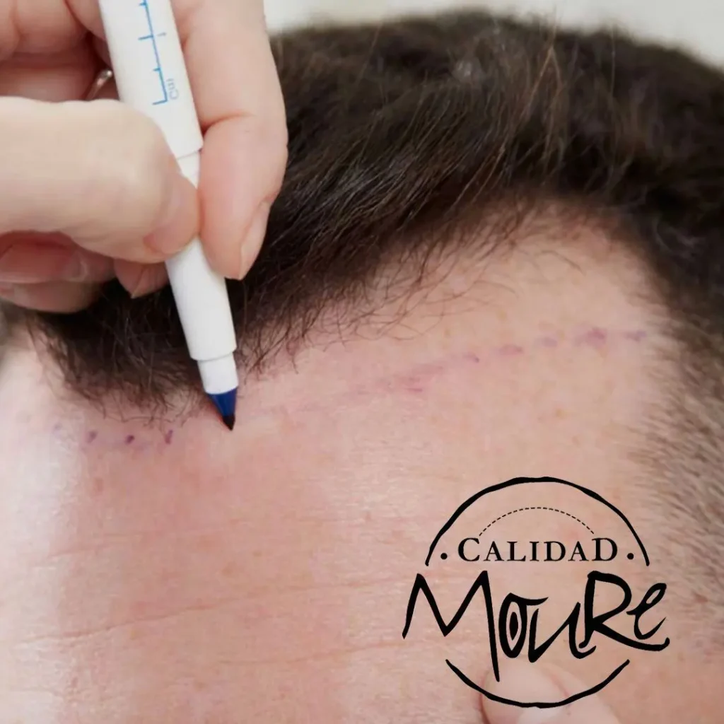 micropigmentacion-capilar-hombre-relleno-pelo-largo-6-1