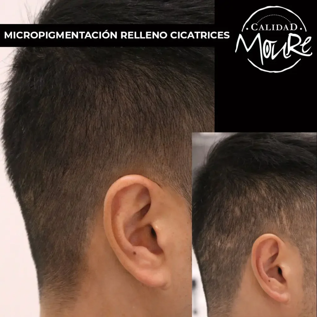 micropigmentacion-capilar-hombre-relleno-pelo-largo-7-1