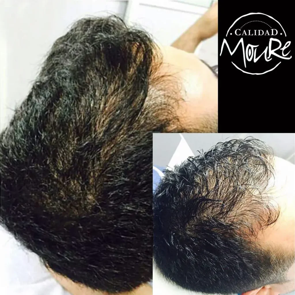 micropigmentacion-capilar-hombre-relleno-pelo-largo-8