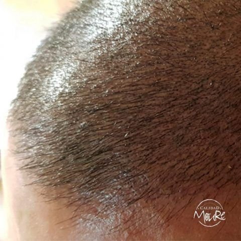 micropigmentacion-capilar-mallorca-calvicie-relleno-pelo-largo-07-480x480