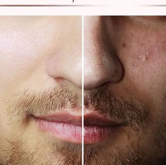 TRATAMIENTO FACIAL HOMBRE ANTES Y DESPUES BARBERIA PELUQUERIA MALLORCA MOURE (10)